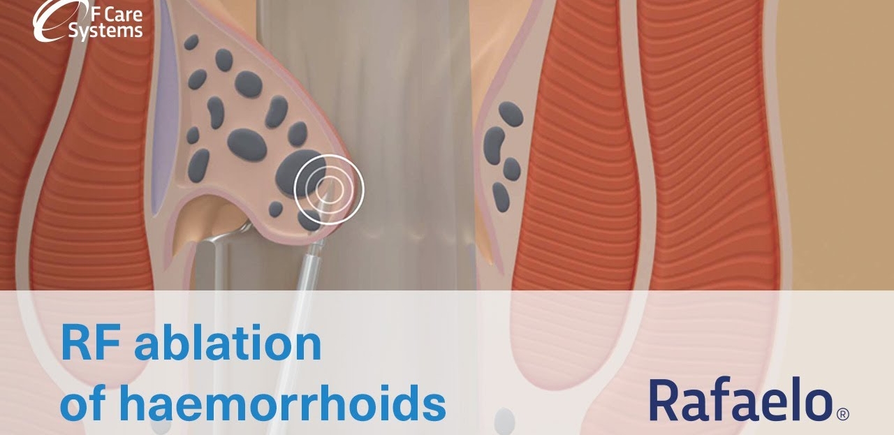 Rafaelo procedure