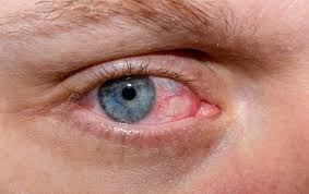 Understanding Dry Eye Disease: A Multifaceted Challenge