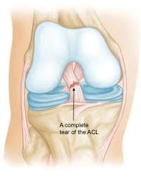 Anterior Cruciate Ligament (ACL) Tears: Causes, Symptoms, Treatment and Recovery